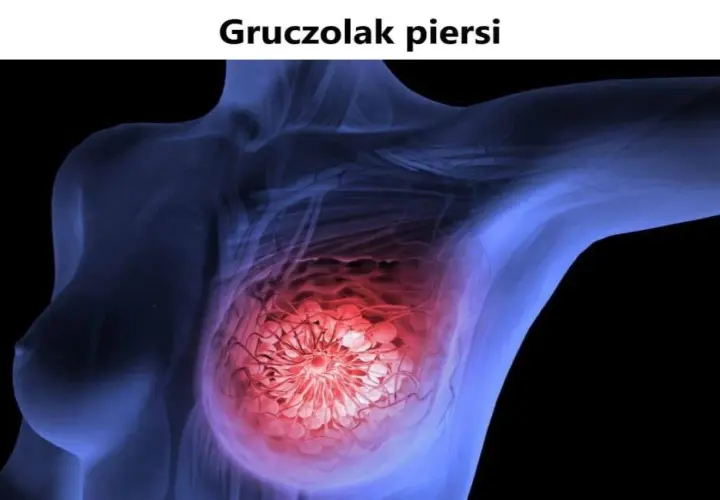 Schemat piersi z uwidocznionym gruczolakiem w czerwonym kolorze.