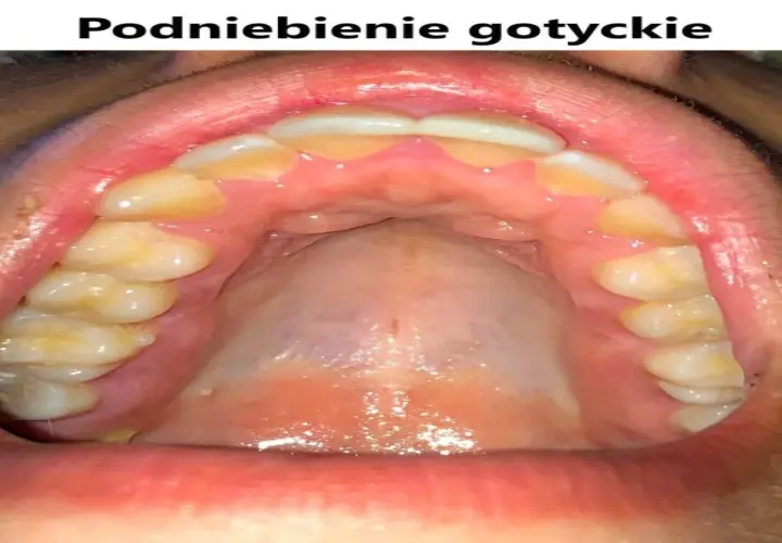 Widok jamy ustnej z zębami i podniebieniem. Charakterystyczne, wysokie podniebienie gotyckie, z widocznymi zębami trzonowymi i przedtrzonowymi.