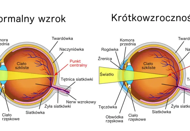 Porównanie budowy oka z krótkowzrocznością i normalnym wzrokiem. Światło skupia się przed siatkówką.