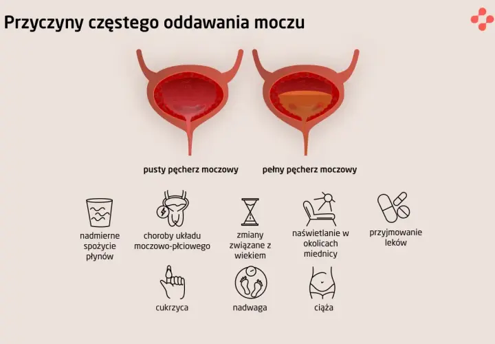 Ilustracja przedstawia pęcherz moczowy pusty i pełny, wyjaśniając przyczyny częstego oddawania moczu, w tym poliurię, np. nadmierne picie, choroby, wiek, leki, cukrzycę, nadwagę, ciążę.