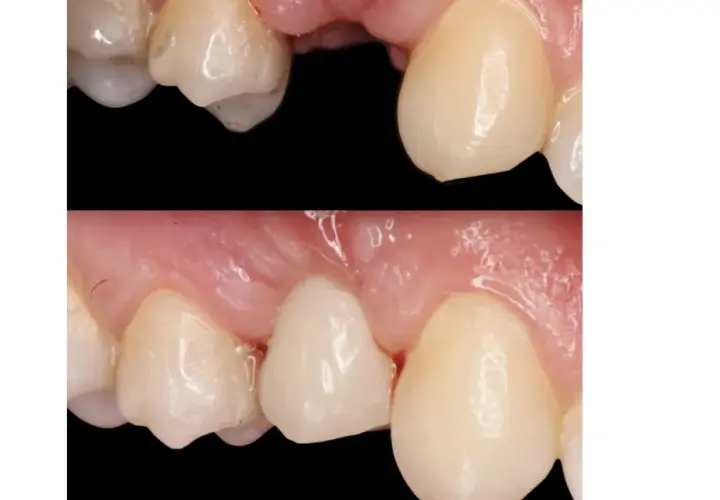 Prima e dopo un ponte dentale Maryland. Si notano i potenziali svantaggi: recessione gengivale e possibile infiltrazione.