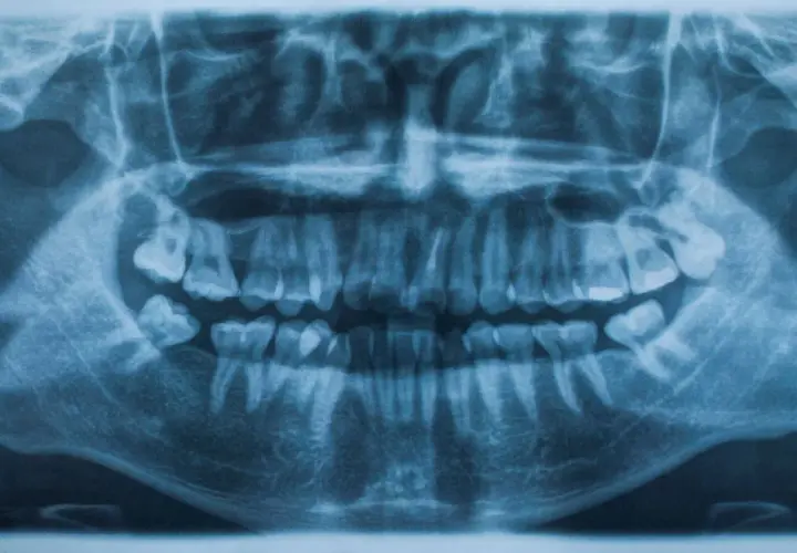 Radiografía panorámica dental que muestra la dentadura completa. Se aprecian signos de posible traumatismo dental, como dientes fracturados o desplazados.