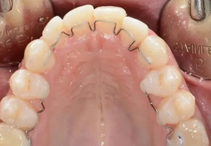 Dente cariato con apparecchio ortodontico. La carie è visibile su un dente, mentre gli altri sono allineati da un filo metallico.
