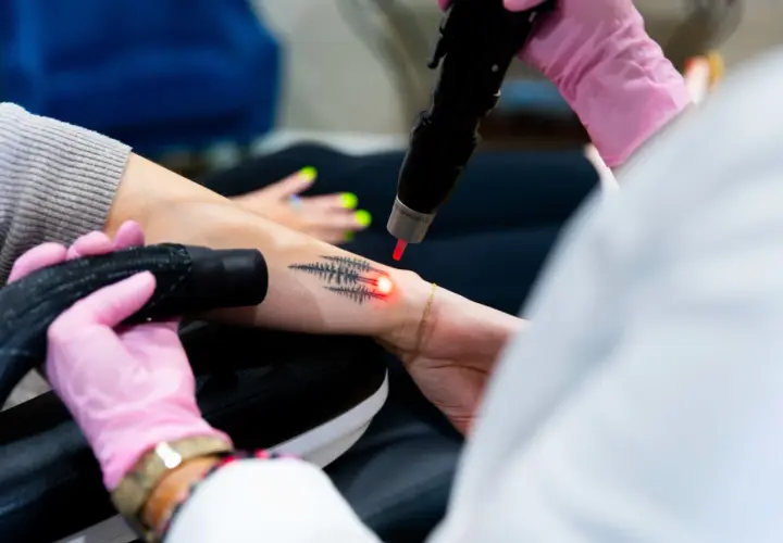 En person får bort en gammal lasra tatuering med en laserbehandling.