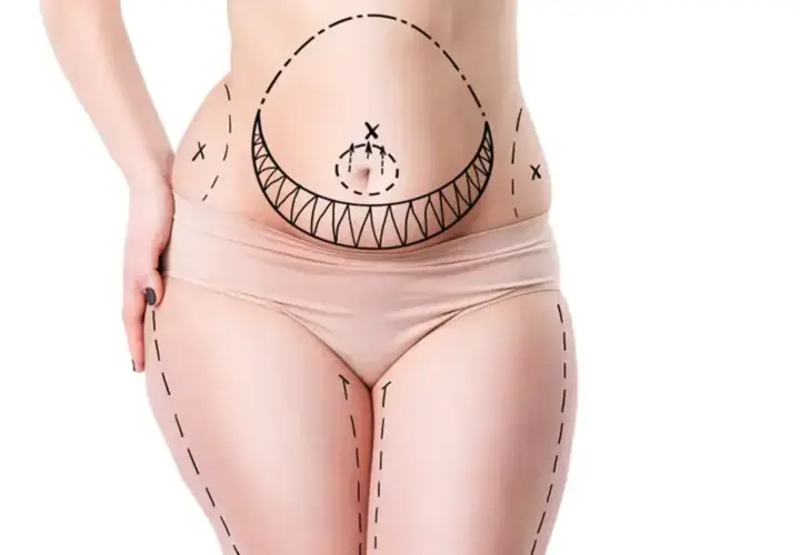 Kropp med markerade linjer för fettsugning, visar områden för vaser liposuction.