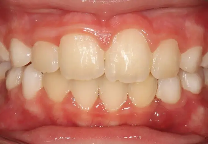 Dientes alineados y encías sanas, un vistazo al progreso de Invisalign mes a mes.