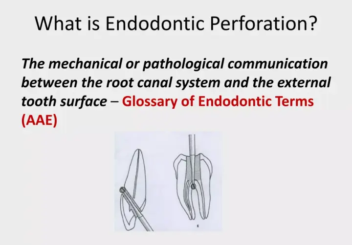 Co to jest perforacja endodontyczna? Ilustracja pokazuje komunikację między systemem kanałów korzeniowych a zewnętrzną powierzchnią zęba.