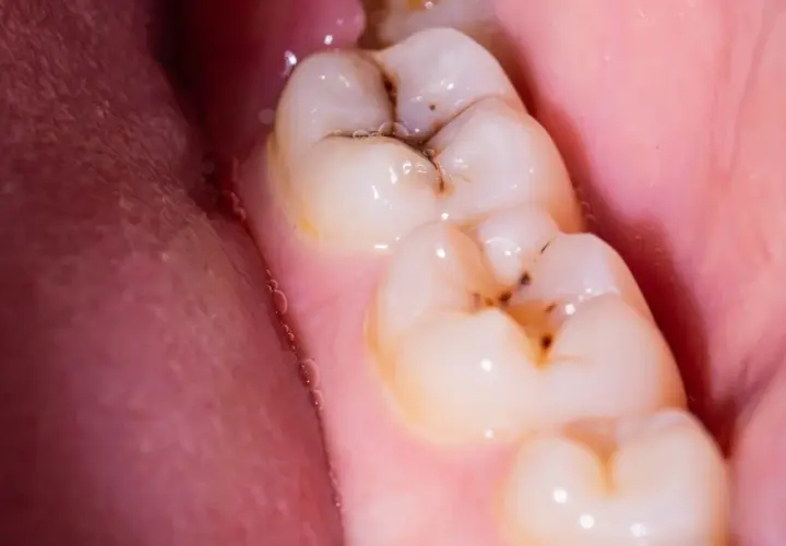 Muelas con caries y encía rosada. Para empastar una muela hace falta anestesia, ¡pero el resultado vale la pena!