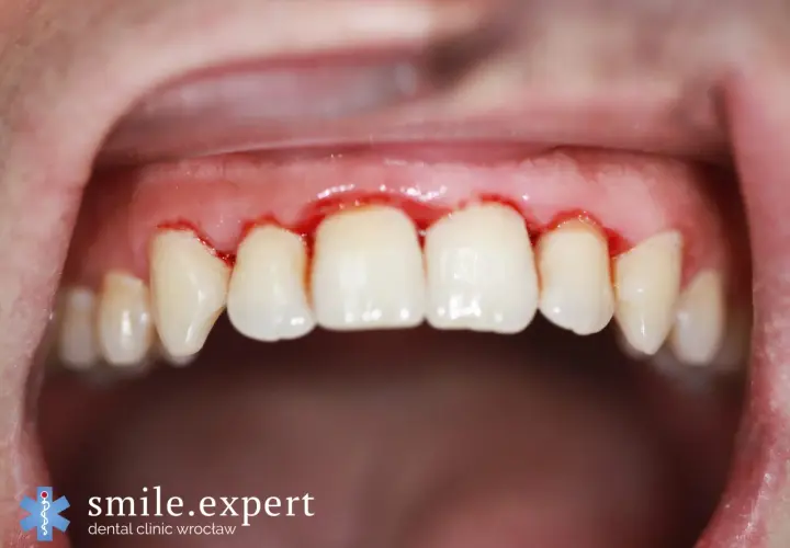Jak leczyć stan zapalny dziąseł? Domowe sposoby i dentysta