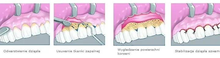 Ile trwa zdjęcie szwów z dziąsła? Szybki i bezbolesny proces