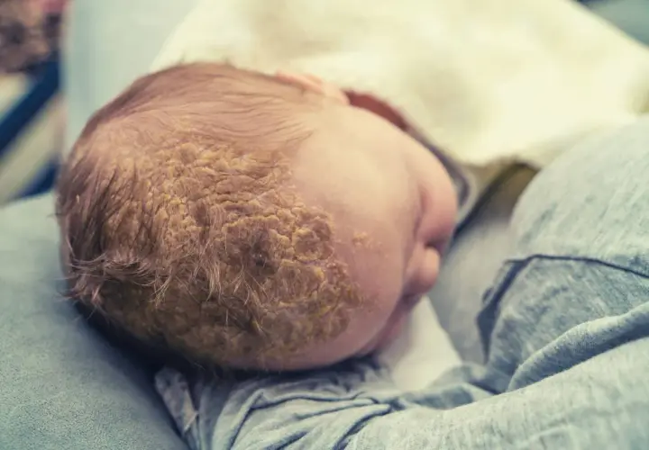 Testa di neonato con croste di dermatite seborroica, comunemente chiamata "crosta lattea".