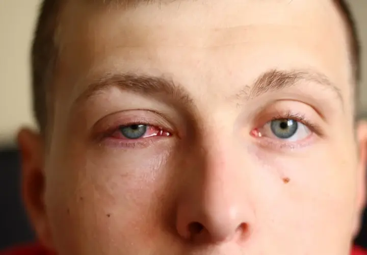 Œil rouge et irrité, signe de conjonctivite. Que faire pour soulager cette gêne ?