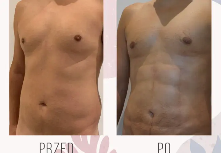 Ile kosztuje zabieg liposukcji? Sprawdź ceny i ukryte koszty