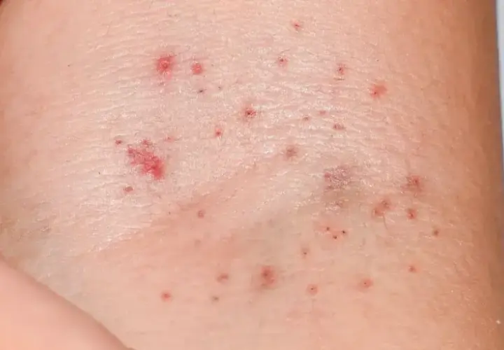 Pelle con piccole macchie rosse, che potrebbero indicare petecchie. Cosa sono? Piccoli sanguinamenti sotto la pelle.