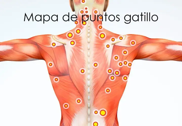 Mapa de puntos gatillo en la musculatura de la espalda y hombros.