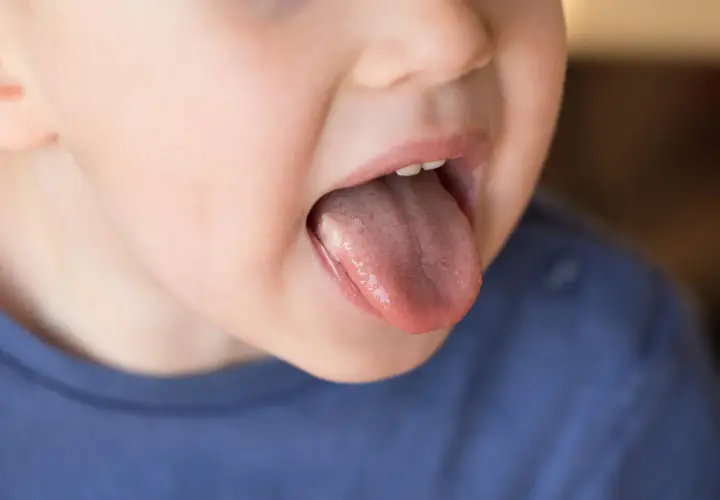 Dziecko pokazuje język z białym nalotem. Szukamy pypeć na języku domowe sposoby.