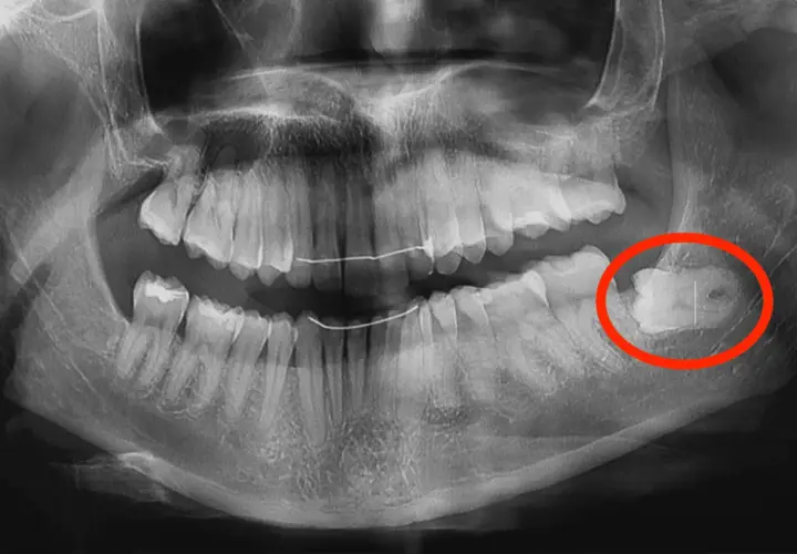 Radiografia dentale mostra un dente cariato, evidenziato in rosso. Fa male togliere una carie, ma è necessario per la salute orale.