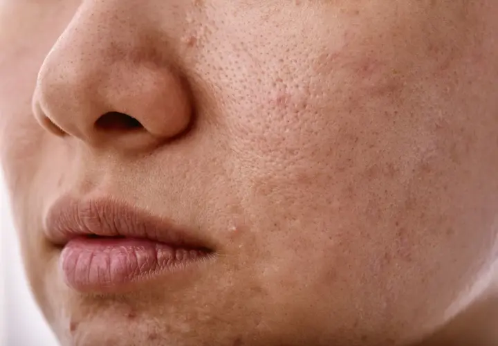 Skóra z widocznymi porami i niedoskonałościami. Nadmiar sebum może prowadzić do takich zmian.