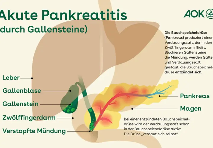 Illustration zeigt Gallensteine, die die Mündung blockieren und eine akute Pankreatitis auslösen. Symptome können durch diese Blockade entstehen.