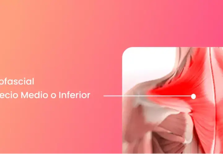 Dolor miofascial en el trapecio medio o inferior, con área inflamada en rojo.