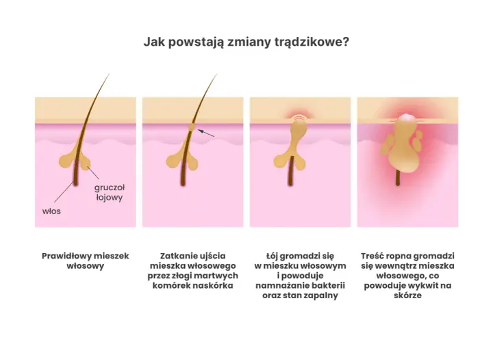 Ilustracja pokazuje, jak powstaje trądzik bakteryjny: zatkanie mieszka włosowego, namnażanie bakterii i stan zapalny prowadzący do ropnych wykwitów.