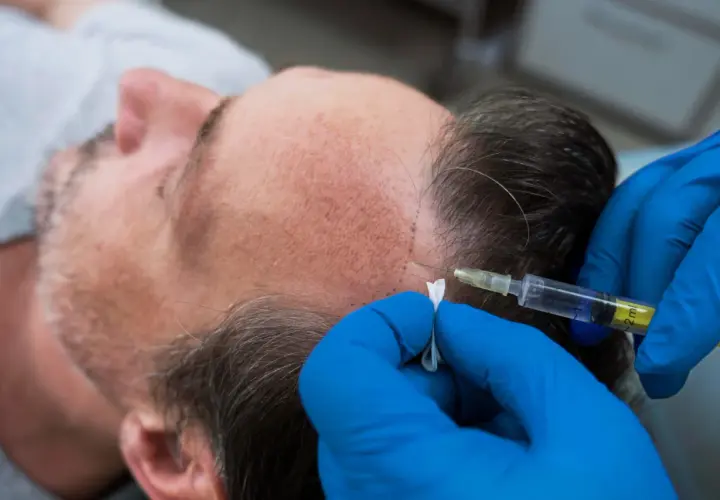 Man recibe tratamiento de cauterización capilar con inyección en la línea del cabello.