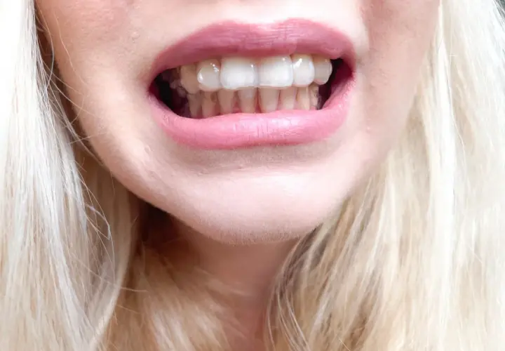 Uśmiech z widocznymi, przezroczystymi nakładkami Invisalign na zębach.