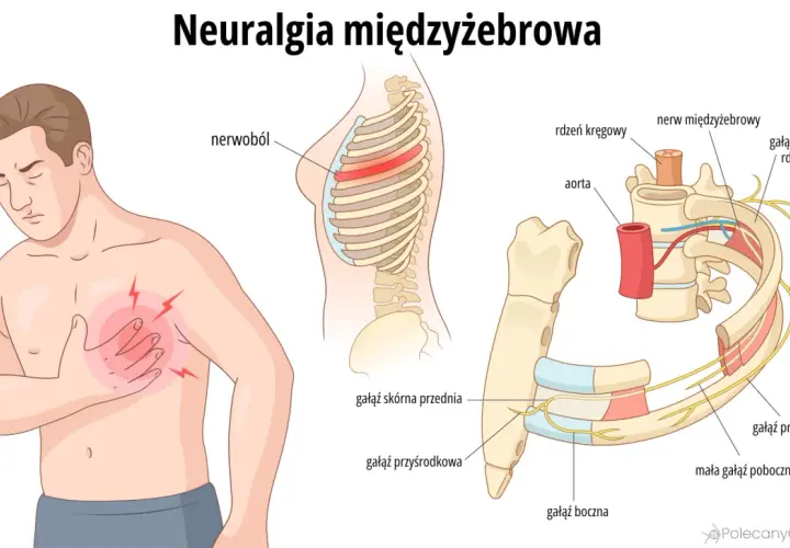 Ilustracja pokazuje ból w klatce piersiowej, objawy neuralgii międzyżebrowej i anatomię nerwów.