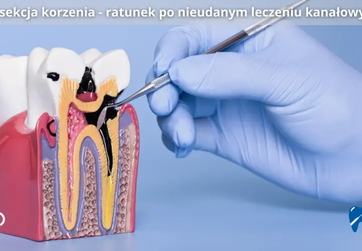 Model zęba z widocznym uszkodzeniem po leczeniu kanałowym. Dłoń w rękawiczce stomatologicznej wykonuje zabieg resekcji wierzchołka korzenia.