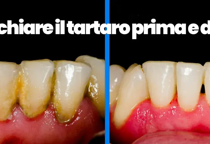 Denti con tartaro sottogengivale prima e dopo la pulizia.