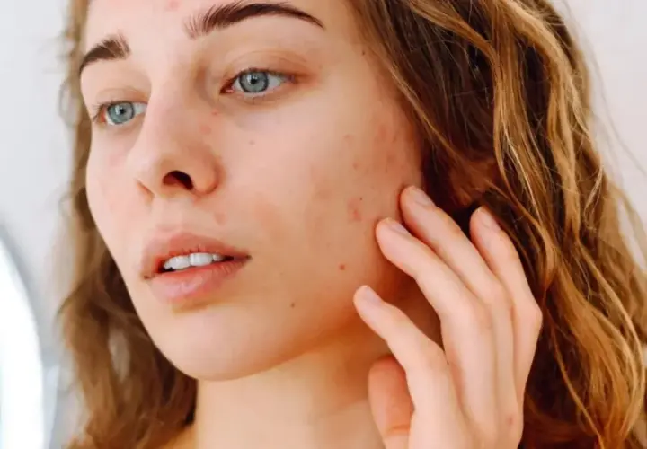 Une jeune femme aux yeux bleus touche son visage, marqué par des rougeurs et des imperfections. Elle cherche à hydrater le visage pour retrouver une peau nette.