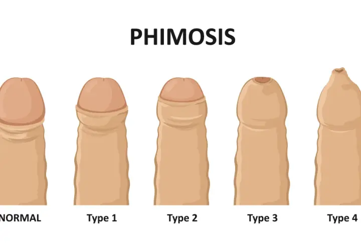 Ilustracja pokazuje stopnie stulejki (phimosis). Porównuje normalny stan z czterema typami, gdzie napletek co to jest, jest widocznie zwężony.