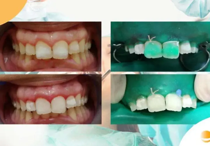 Denti con macchie bianche prima e dopo il trattamento. Si vedono i denti preparati e isolati con diga di gomma, pronti per il restauro.