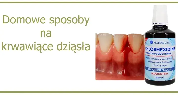 Jaki lek na zapalenie dziąseł? Skuteczne metody i domowe sposoby