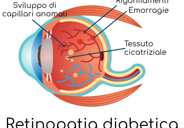 Illustrazione dell'occhio che mostra i danni della retinopatia diabetica: capillari anomali, emorragie e tessuto cicatriziale.