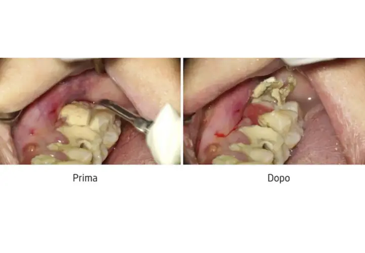 Prima e dopo la rimozione di un **tartaro grave**. La gengiva è infiammata e i denti sono coperti da depositi giallastri.