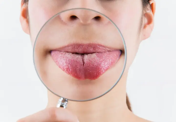 Lingua spaccata, un problema comune. Scopri i rimedi naturali per alleviare il fastidio e favorire la guarigione.