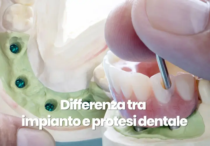 Modello dentale con impianti e una protesi dentale in fase di lavorazione.