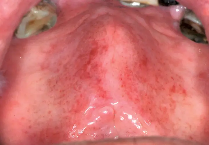 Palato con aree arrossate e puntini rossi, indicativi di una lesione palato. Si notano anche piccole protuberanze.
