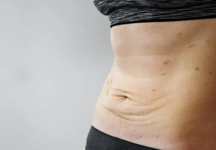 Luźna skóra po schudnięciu 20 kg, widoczne rozstępy i przebarwienia na brzuchu.