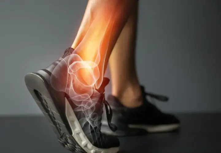 Anatomia skręconej kostki z widocznymi kośćmi i zapaleniem.