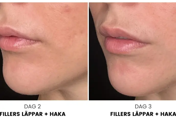 Före- och efterbilder av läppar och haka efter konsultation med fillers. Dag 2 och dag 3 visar en tydlig förbättring.