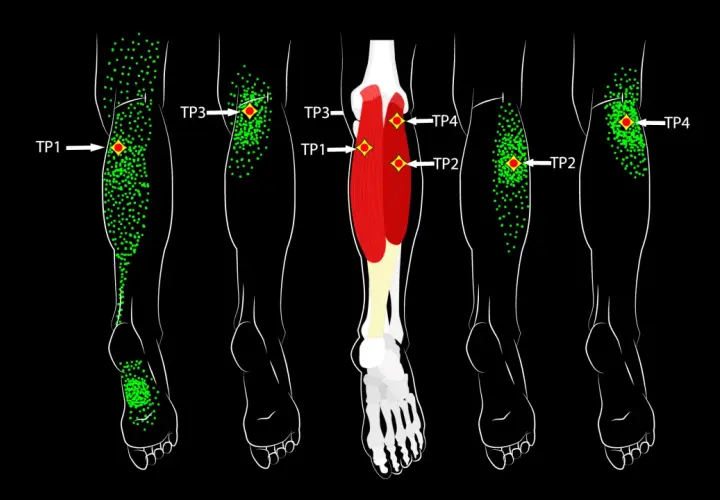 Schéma des jambes montrant des points verts indiquant des zones de douleur et des points rouges marquant la zone gâchette.