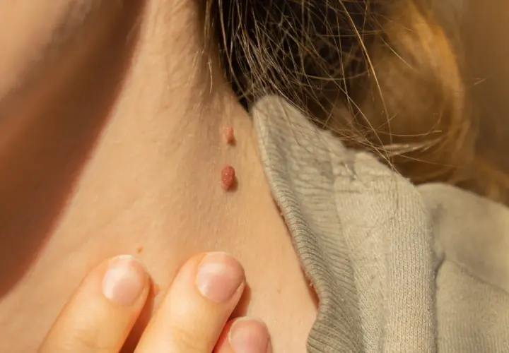 Gros plan sur le cou d'une personne montrant deux acrochordons, aussi appelés grains de beauté, près d'un col de vêtement.