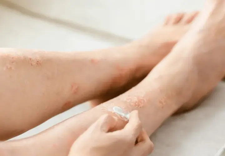 Osoba aplikuje krem locoid lipocream na skórę nóg z widocznymi zmianami łuszczycowymi.