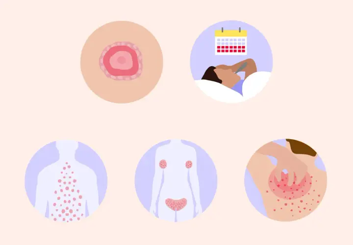 Immagine illustra la pitiriasi rosea di Gibert, con un medaglione iniziale, eruzione cutanea diffusa, e un'icona che suggerisce stress e malessere.