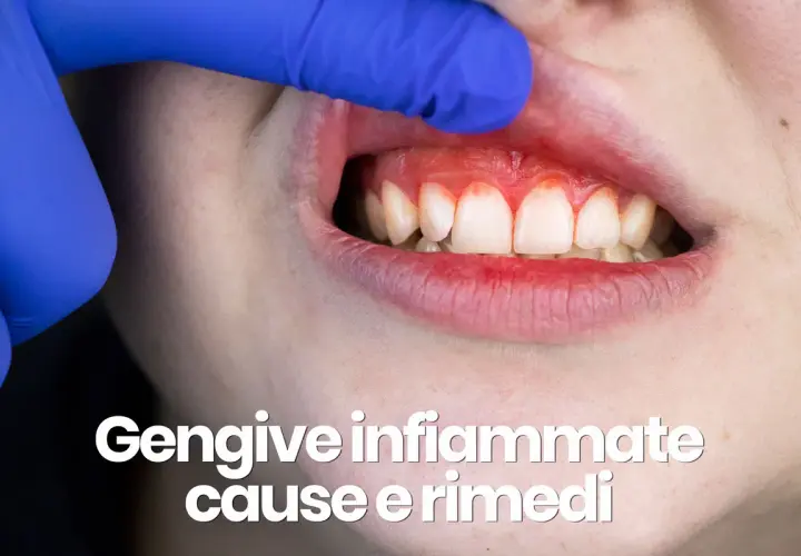 Dente con gengive rosse e gonfie, segno di dolore alle gengive che non passa. Esplorazione con guanto blu.
