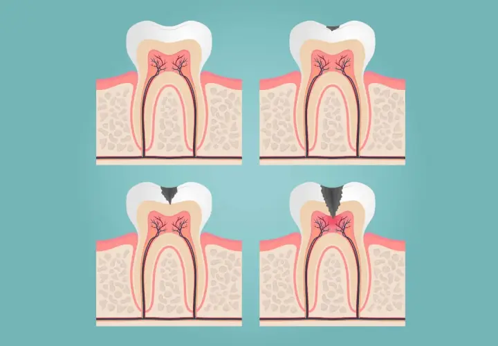 Ilustración de un diente con caries progresiva, mostrando la necesidad de un empaste o endodoncia para salvarlo.