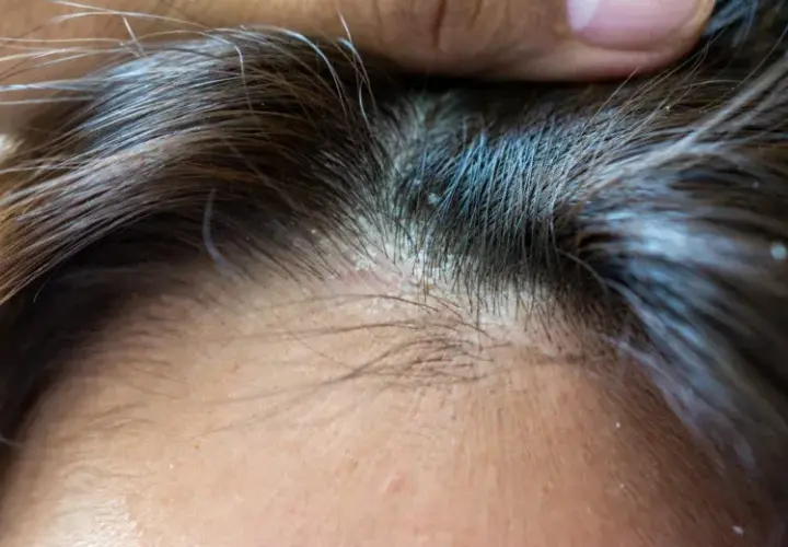 Jak stosować peeling do włosów, aby uniknąć problemów z łupieżem