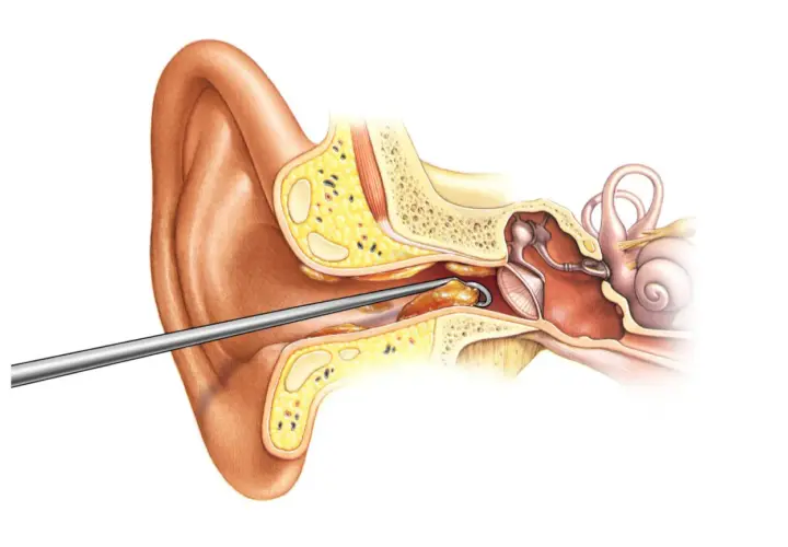 Instrumento extrae un tapón de cera del oído. El cerumen obstruye el canal auditivo, afectando la audición.
